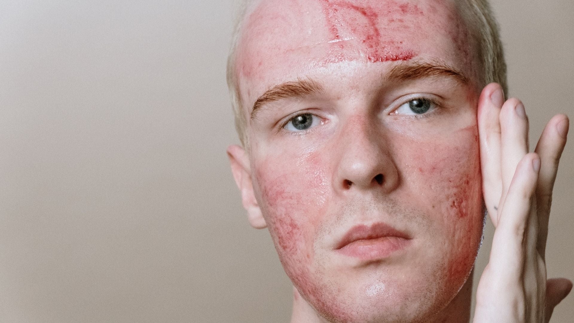 Exfoliating With Acne: Here’s Everything You Need to Know – DemarkQ